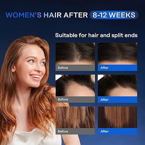 Suero para el crecimiento del cabello, 5% minoxidil y biotina para hombres y mujeres, tiene la pérdida de cabello.