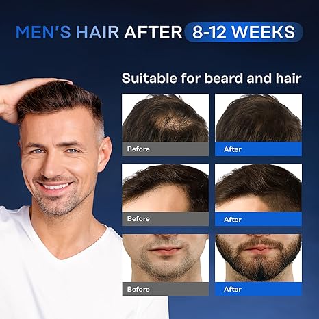 Suero para el crecimiento del cabello, 5% minoxidil y biotina para hombres y mujeres, tiene la pérdida de cabello.